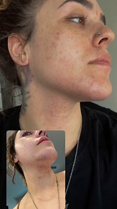 104K views · 289 reactions | Bearded lady chronicles! 來✨ Jk, PCOS is...