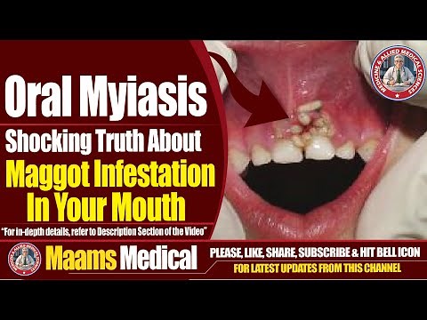 Oral Myiasis | Shocking Truth About Maggot Infestation In Your Mouth | Maams