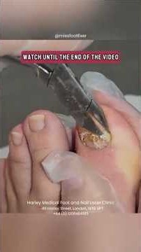 A damaged toenail can often be improved with the right care. 👣