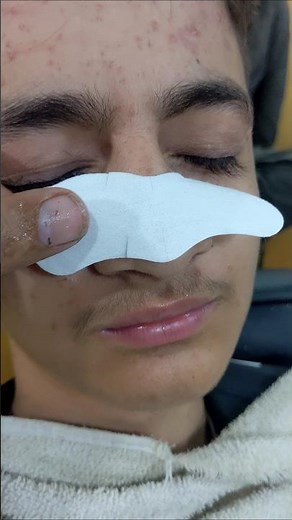 blackheads removal sac dep spa nose strips #asmr #relaxer #asmrsounds #relaxant #relaxingmassage