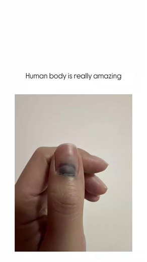 Multiverse ™🇺🇸 on Instagram: "The post features a time-lapse video of a severely bruised fingernail detaching and fully regrowing over months, illustrating the body's natural regeneration process after trauma like a subungual hematoma.Fingernails regenerate from the nail matrix at about 3-4 mm per month, with full recovery typically taking4-6 months, as supported by dermatological studies in the Journal of Investigative Dermatology.Replies highlight practical tips like relieving pressure by pu