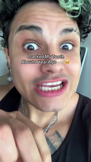 Dealing with a Cracked Tooth: My Year-Long Journey