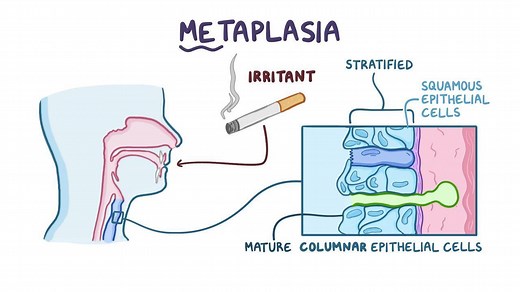 Video: Metaplasia and dysplasia - Video Explanation! | Osmosis | Osmosis