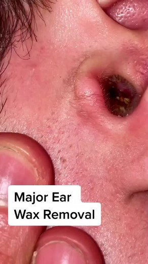 Wax removal from ear #pimple #acne #pimples #blackheads #pimplepopping #skincare #blackhead #pimplepopper #whiteheads #pimplepoppers #whitehead #blackheadextraction #blackheadremoval #cyst #pimplepop #drpimplepopper #pimplesremover #zit #pores #skin #whiteheadextraction #drsandralee #beauty #acnetreatment #cystremoval #zits #whiteheadremoval #jerawat #skincareroutine #pimpleremover