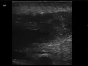 case 562 ULTRASOUND PILONIDAL CYST ,SINUS