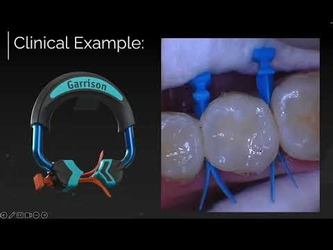 Advantages of 4 Quad Rings in the Kit | Quad Matrix System