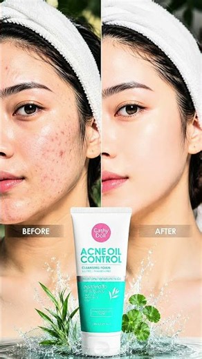 Cathy Doll Acne Oil Control Cleansing Foam | Oily Skin & Acne Care Face Wash