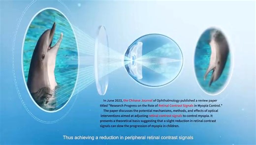 👓 Introducing LARI™ Myopia Control Lenses Lenslet-ARray-Integrated Spectacle Lenses We are excited to introduce LARI lenses—an advanced solution for myopia (nearsightedness) control in children. These innovative spectacle lenses use micro-structured components and array-patterned lenslets to gently alter the way light enters the eye, creating a controlled retinal image blur that helps slow down the progression of myopia. ✨ Backed by Research • Clinical studies and a recent meta-analysis confirm