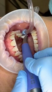 What’s the best way to use the PERIOFLOW®️ Handpiece? 🦷 Before use make sure you have a completed a perio chart and taken x-rays 🦷 Always use with EMS AIRFLOW®️ PLUS Powder only 🦷 Use each time up to a maximum of 5 seconds 🦷 Gently insert the nozzle into the pocket – if the nozzle cannot penetrate sufficiently – do not force 🦷 Make continuous vertical oscillations along the pocket (only to be used on pockets 4-9mm) 🦷 Change the nozzle after maximum 20 sites | EMS Dental