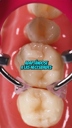 Zeyco on Instagram: "🦷Llevar Unimatrix R a tu consultorio es sinónimo de restauraciones clase dos impecables, este sistema de #TDV está compuesto por matrices seccionales preformadas y anillos con refuerzo con protectores triangulares de silicona. ¡Conócelo a detalle!"