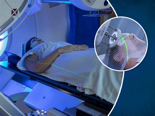 What Are The Side Effects Of Radiation Therapy? Know From An Expert