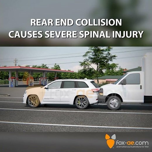 Rear End Collision Causes Severe Spinal Injury