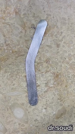 Modified tofflemire band for cevical composite build up in class V and direct composite veneer restorations 📸🪄 From Egypt 🇪🇬 with Love ❤️ #dentist #libya #dentistry #mansoura #composite #isolation #الاسنان #learn_with_soudi #dentist #dentistry #dentista #mansoura #dentistryworld #libya #dentistrylove #ابتسامة #dentiste #dentistas #composite #isolation #rubberdam #its_showtime #المنصورة #passion #esthetics #share #endo #endodontics #endodontics #soudi_dental_care #endodontia #endodontist #ins