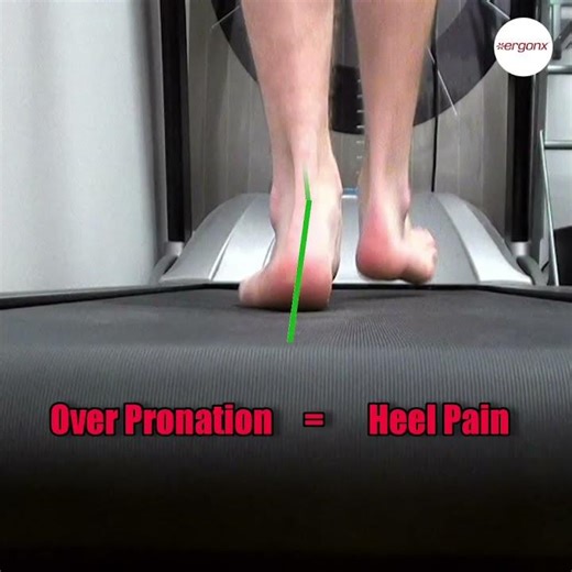 When your feet roll in too much (overpronation), the plantar fascia gets overstretched every single