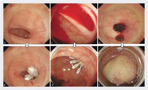 Useful treatment selection strategy for endoscopic hemostasis in colonic diverticular bleeding according to endoscopic findings (with video)