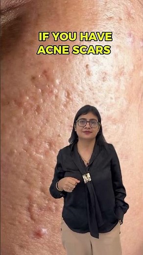 Acne Marks or Acne Scars? Dermatologist Explains