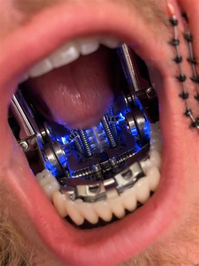 Jake Paul Muestra Su Nueva Mandíbula de Acero