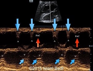 Blocked atrial trigeminy resulting in fetal bradyarrhytmias