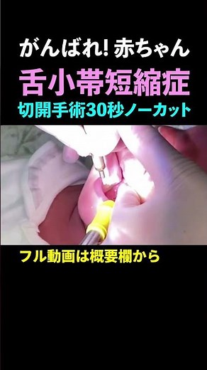 【舌小帯短縮症／赤ちゃん】切開手術30秒ノーカット（口腔外科専門医 安原豊人）#shorts