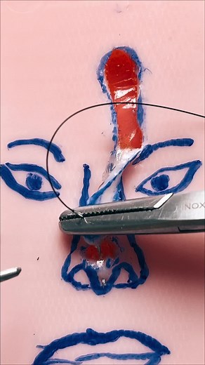 Paramedian forehead flap: suture