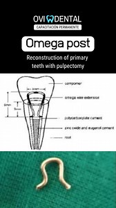 ► Omega post. Reconstruction of primary teeth with pulpectomy #OmegaPost #PrimaryTeeth #Ovidental | OVIdental Go | Facebook