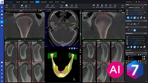 How to – Automatically create TMJ views in Planmeca Romexis