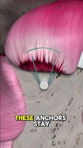 Rotator cuff repair surgery? #medical #medsurgery #surgery