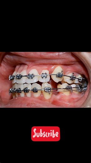 Amazing Braces Transformation | Teeth Alignment Progress Before & After #smiletransformation #teeth