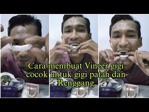 Cara membuat veneer/baju gigi dari Temptooth, cocok untuk menutupi gigi renggang, patah atau jelek.
