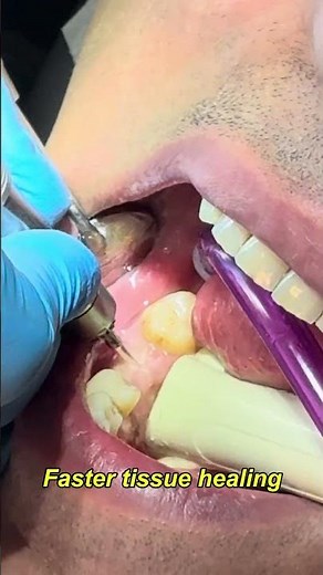 Why Er:YAG Laser Is a Game-Changer in Modern Dentistry! | Pain-Free, Precise & Fast Recovery