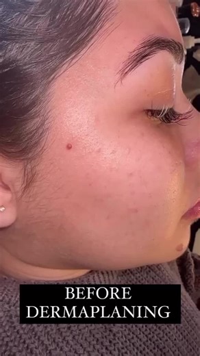 What is a Dermaplane Facial? …. Dermaplaning is a form of exfoliation. It removes the first layer of dead skin cells and peach fuzz. By doing so, the skin brightens and resembles a much softer, healthy skin barrier. Dermaplaning does not hurt, and the peach fuzz A.K.A “Vellus hair” does not grow back thick. The Dermaplane facial includes double cleansing, steam, extractions, exfoliation by removing the dead skin cells and peach fuzz, a relaxing face massage, selective serums and face masks for d