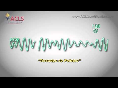Torsades de Pointes by ACLS Certification Institute