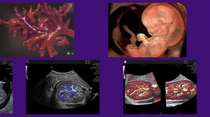 Statistics indicate that the incidence of congenital anomalies in India ranges from 0.84% to 2.9%, and they rank as the fourth leading cause (8.6%) of neonatal mortality and the sixth leading cause of under-five mortality. The past few years have witnessed rapid changes in imaging technology, genetics and evaluation protocols for the fetal brain and spine, opening up several possibilities in fetal medicine. Join us at the global conference, SFM FetalNeurocon 2024, where fetal medicine experts ar