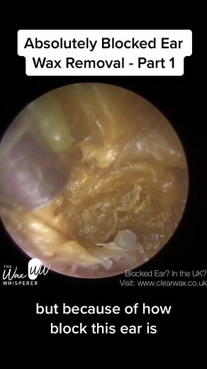 Ear Wax Removal: Expert Tips from The Wax Whisperer