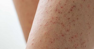 Comment faire disparaître les boutons rouges sur les jambes après rasage ?