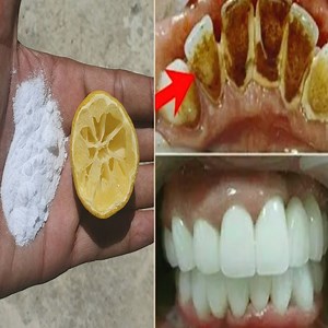 This recipe will lighten dirty yellow teeth like pearl in just 2 minutes. Dental home treatment | Health Zone