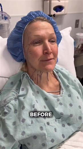 1 year post op, with a lip lift just 2 weeks post op, our patient is beautifully settled into her results. Her goals were to address a drooping midface, excess neck skin, heavy brows, and excess upper eyelid skin, while improving facial balance, jawline definition, and overall harmony. Her comprehensive facial rejuvenation included a Deep Plane Face and Neck Lift, Endoscopic Brow Lift, Upper and Lower Blepharoplasty, CO2 Fractional Laser, and a Lip Lift. At this stage, her results look natural, 