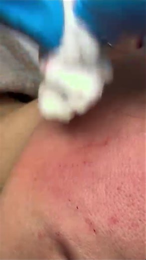 Example of micro-injections for superficial wrinkles