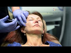 Voluma Injection performed by Dr. Jon Mendelsohn