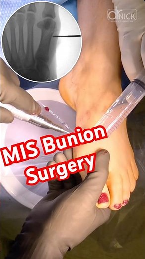 Fixing a bunion in “One Minute!” 😳