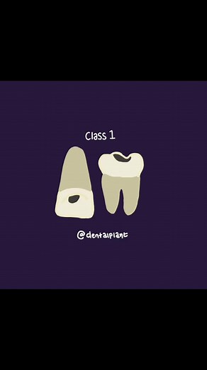 G.V. Black Classification of caries. - - #fyp #trending #foryou #dentistry #dentalstudent #dentaluni #dental
