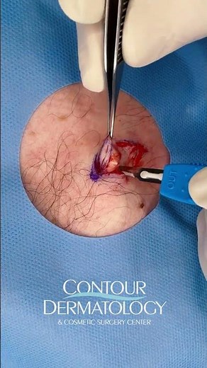 Watch the Entire Cyst Sack Come Out in One Piece 😱 satisfying squeeze at the end.