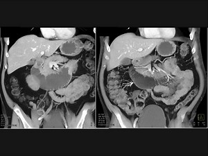 The best dx in this patient with nausea and vomiting is? | CTisus: Cutting edge information on body CT (Computed tomography).
