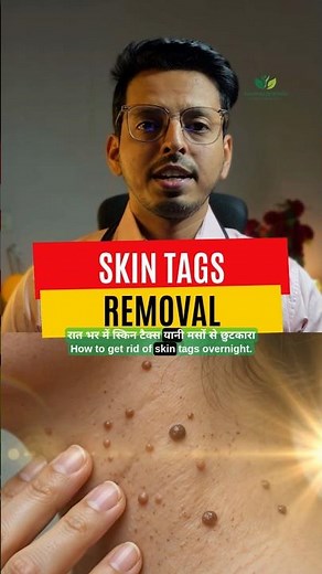 Skin Tags Removal Naturally | Castor Oil & Baking Soda Remedy | Get Rid of Skin Tags Fast