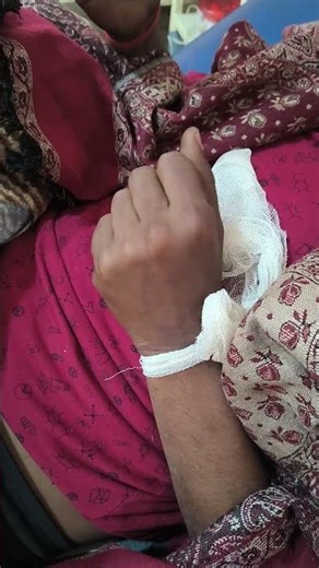 wrist drop #pyrexia symptoms after humerus plating surgery #Nervesprain #funnybones post operative