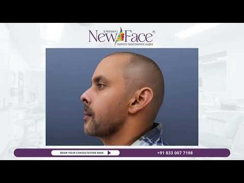 Jaw Surgery Before & After | Face Transformation with Orthognathic Surgery by Dr Mathew PC