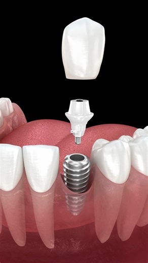 🦷 Why Losing One Tooth Creates a Domino Effect Most people think losing just one tooth isn’t a big deal… but the truth is, it can trigger a chain reaction you don’t see coming. Bone loss, shifting teeth, bite changes — it all starts sooner than you think. In this video, Dr. Rios breaks down what really happens and why replacing a missing tooth on time can save you from bigger, more expensive problems later. Now tell us 👇 Did you know all this happens after losing one tooth… or did this surpris