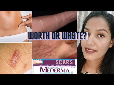 Mederma Scars Gel Worth or Waste? Burn scars,chiken pox scars,cut marks,acne scars,stretch marks