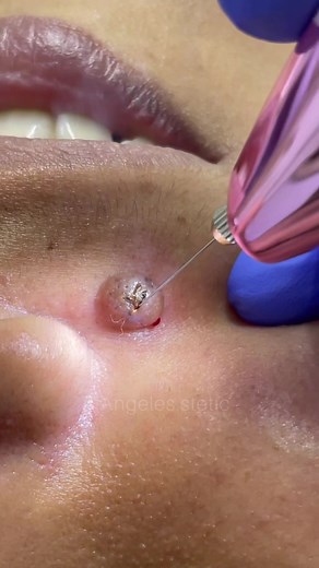 Effective Skincare: Pimple Extraction Procedure Explained