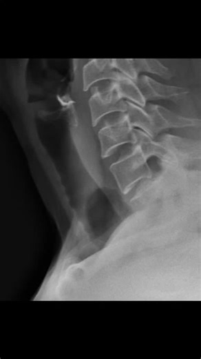 Radiology @all abnormalities 🥏🥏 on Instagram: "Clinical Presentation: Non-traumatic cervical pain. No other complaints. Patient Data: Age: 45 years Gender: Female --- Findings: Left paratracheal region (normal comparative view) shows: Normal trachea, oesophagus, thyroid gland, and major neck vessels. Right lower cervical region: A well-defined air-containing cystic focus is noted adjacent to the right lower pole of the thyroid gland, along the right paratracheal area. The air pocket produces p